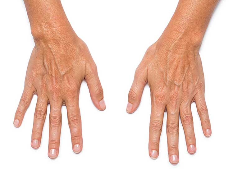 hand rejuvenation with fillers new york city